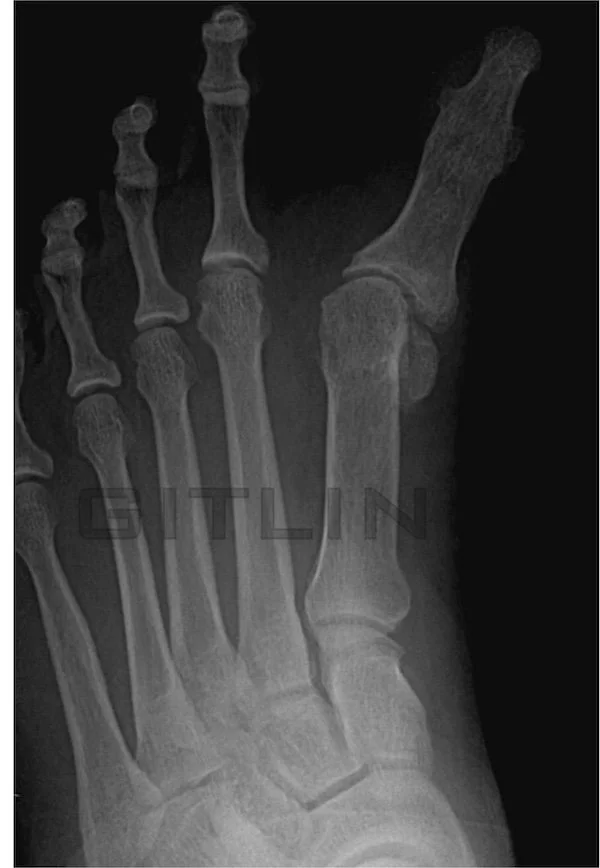 HALLUX VARUS BUNION SURGERY COMNPLICATION REVISION