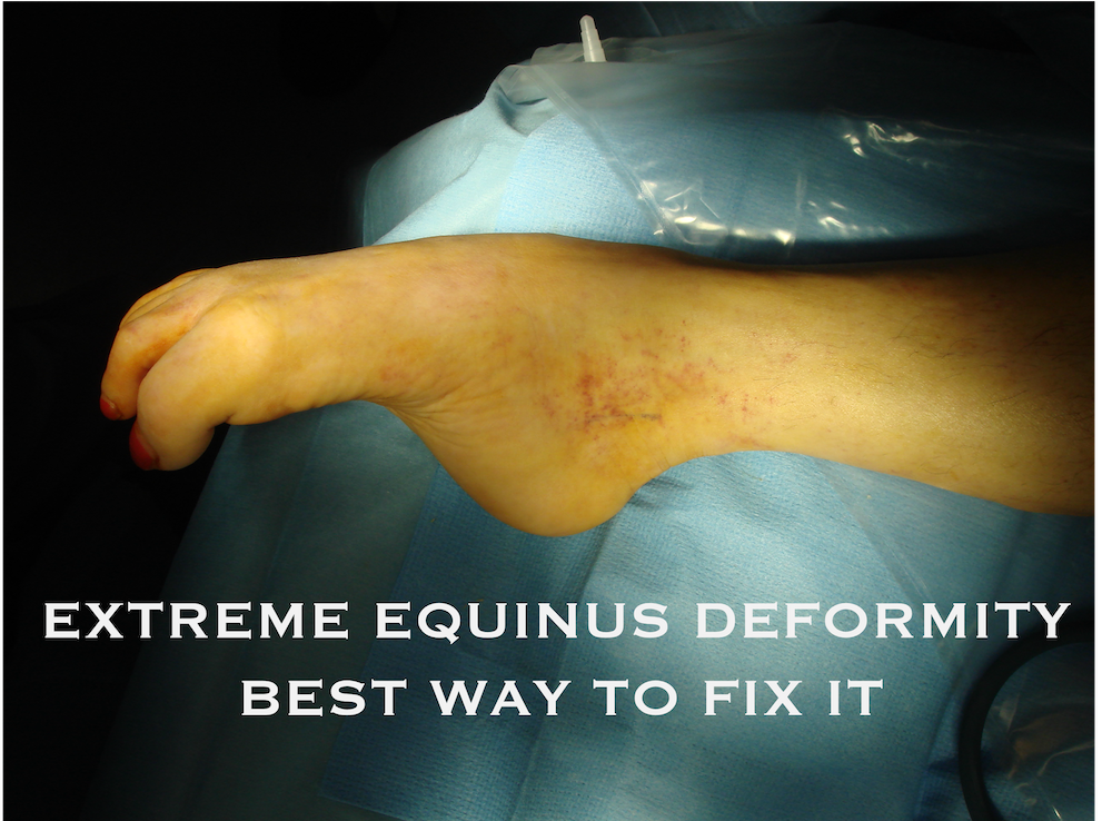 EQUINUS DEFORMITY