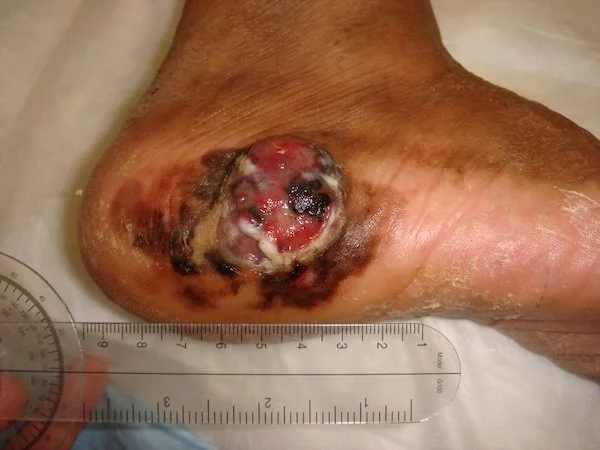 Close-up of an infected, ulcerated cancer of foot