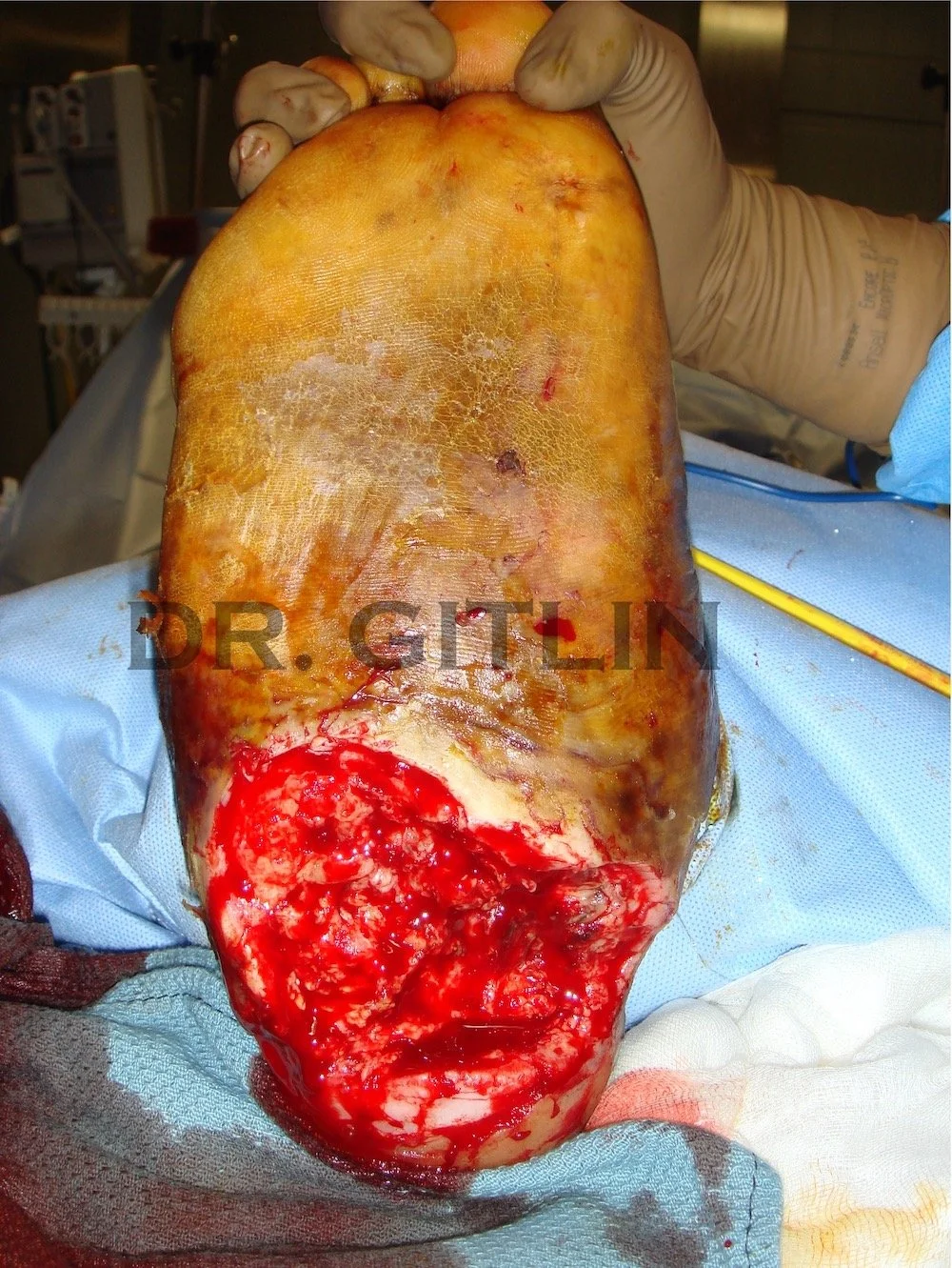 DIABETIC FOOT ULCER CHARCOT JOINT