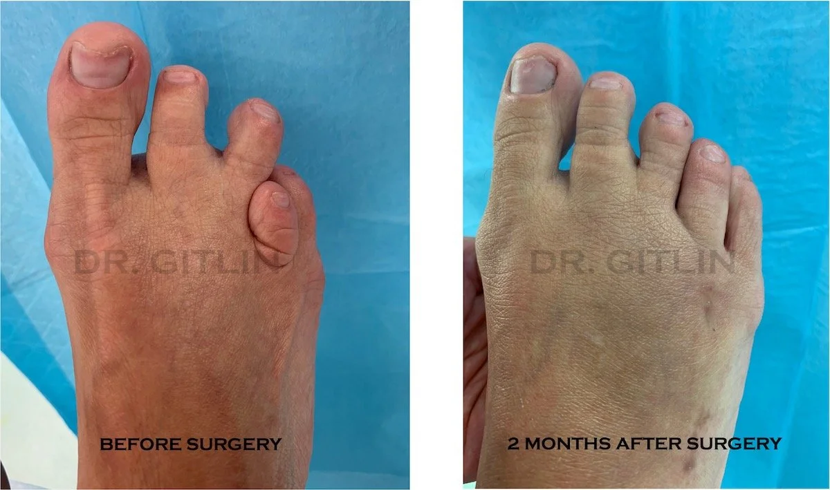 Comparison of a person's hand before and two months after surgery, showing improvement bunion and hammertoes