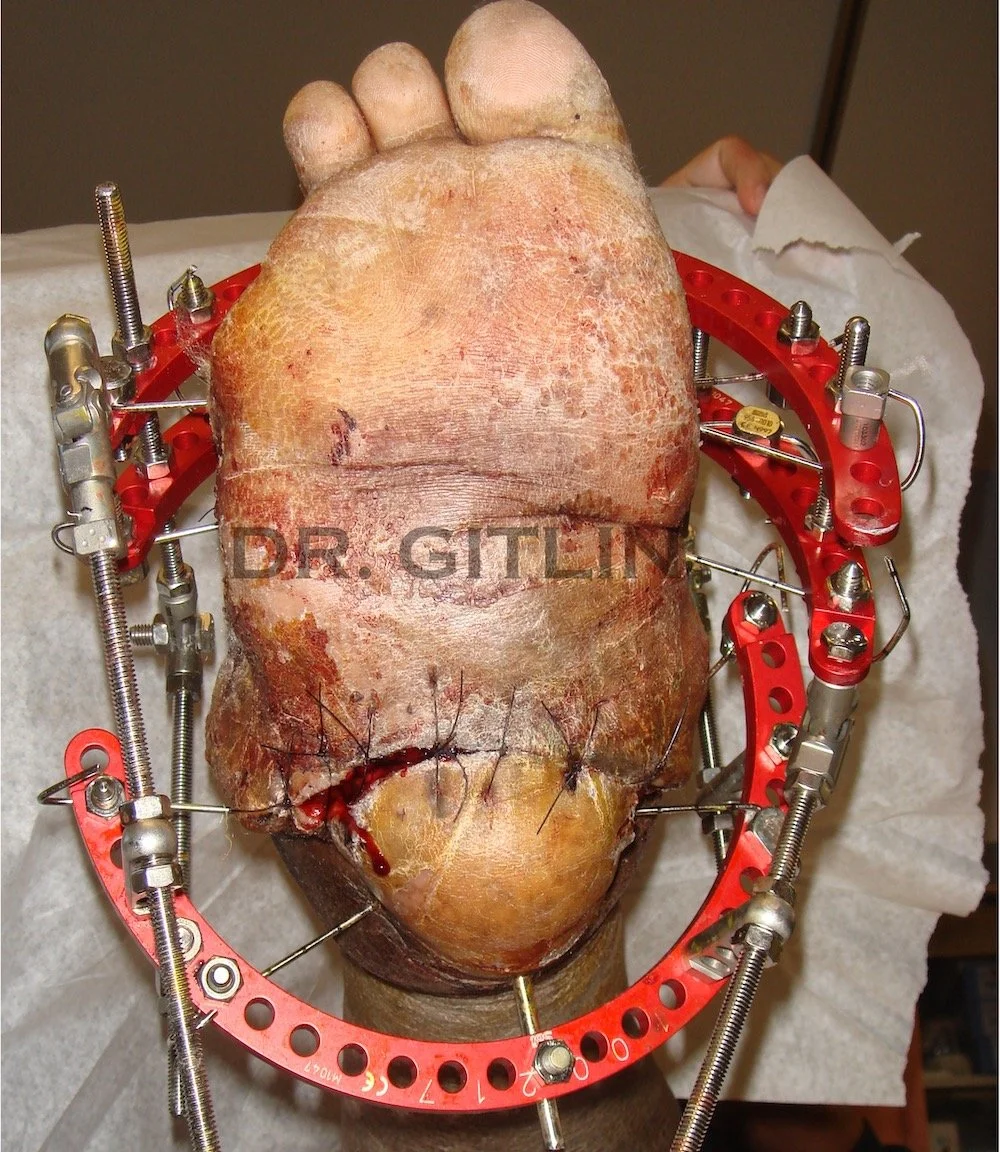 charcot advanced limb salvage surgery expert surgeon