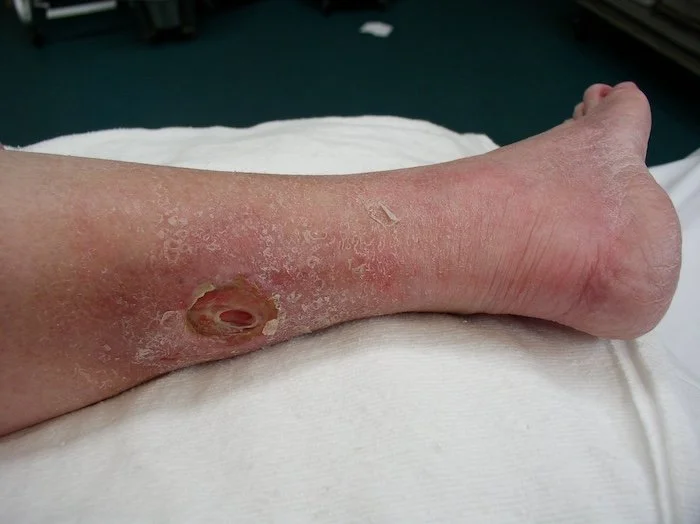 Close-up of a person's lower leg showing severe dry skin and a large open wound with surrounding redness and inflammation.