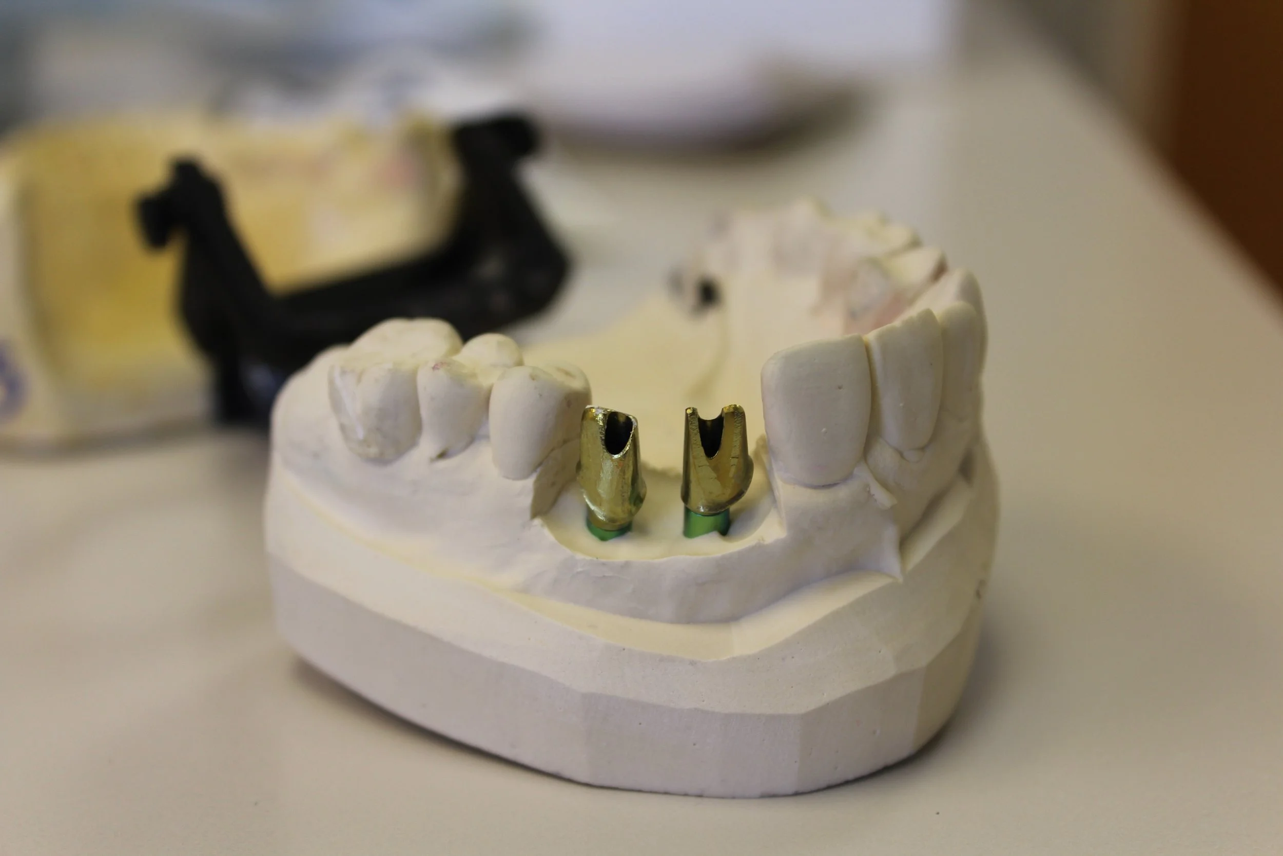 Missing Teeth: Options to Restore Your Smile