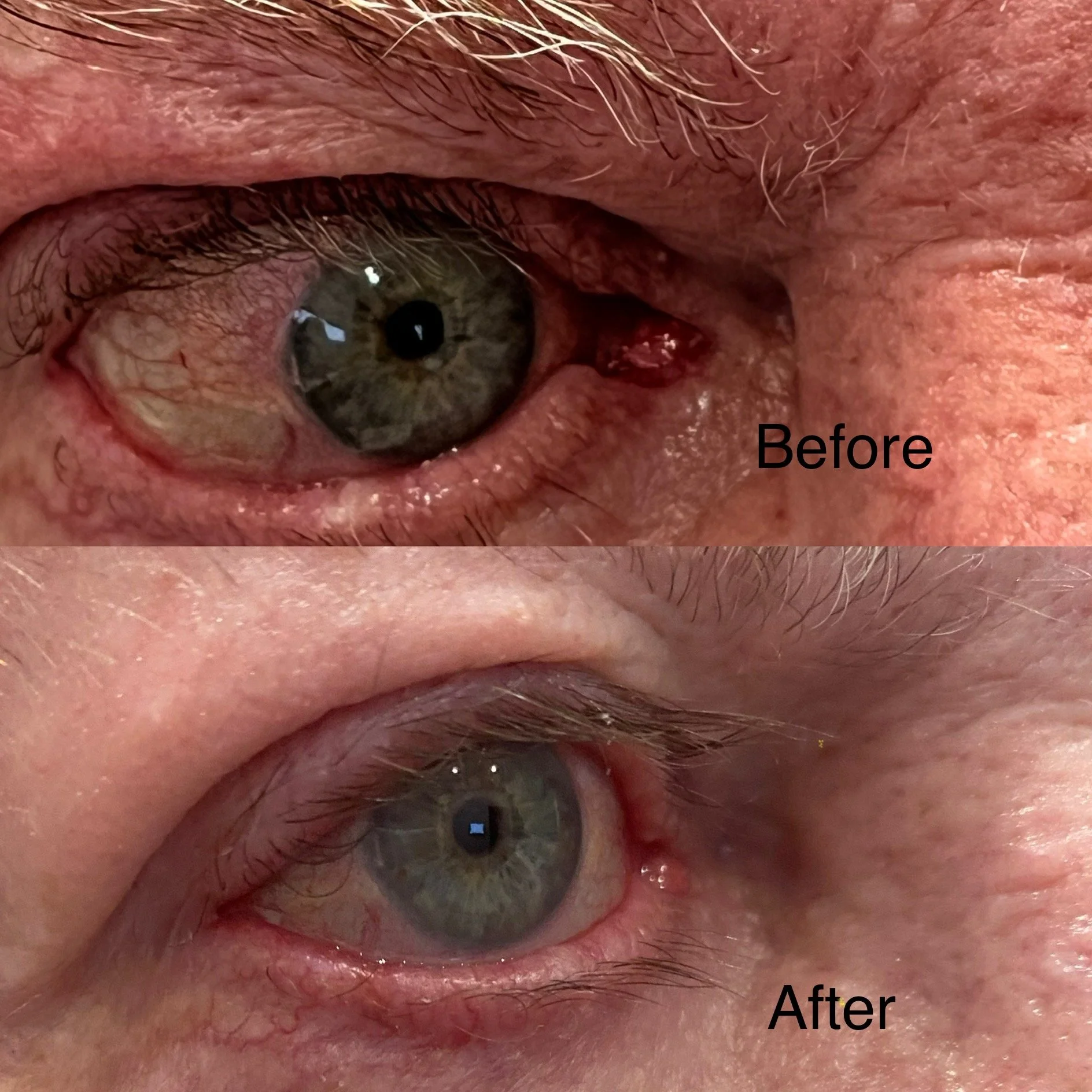 Demodex Eyelid Mites: The Hidden Cause of Itchy, Irritated Lids