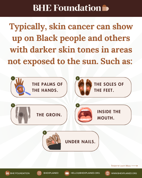skin cancer can show up on Black people.png