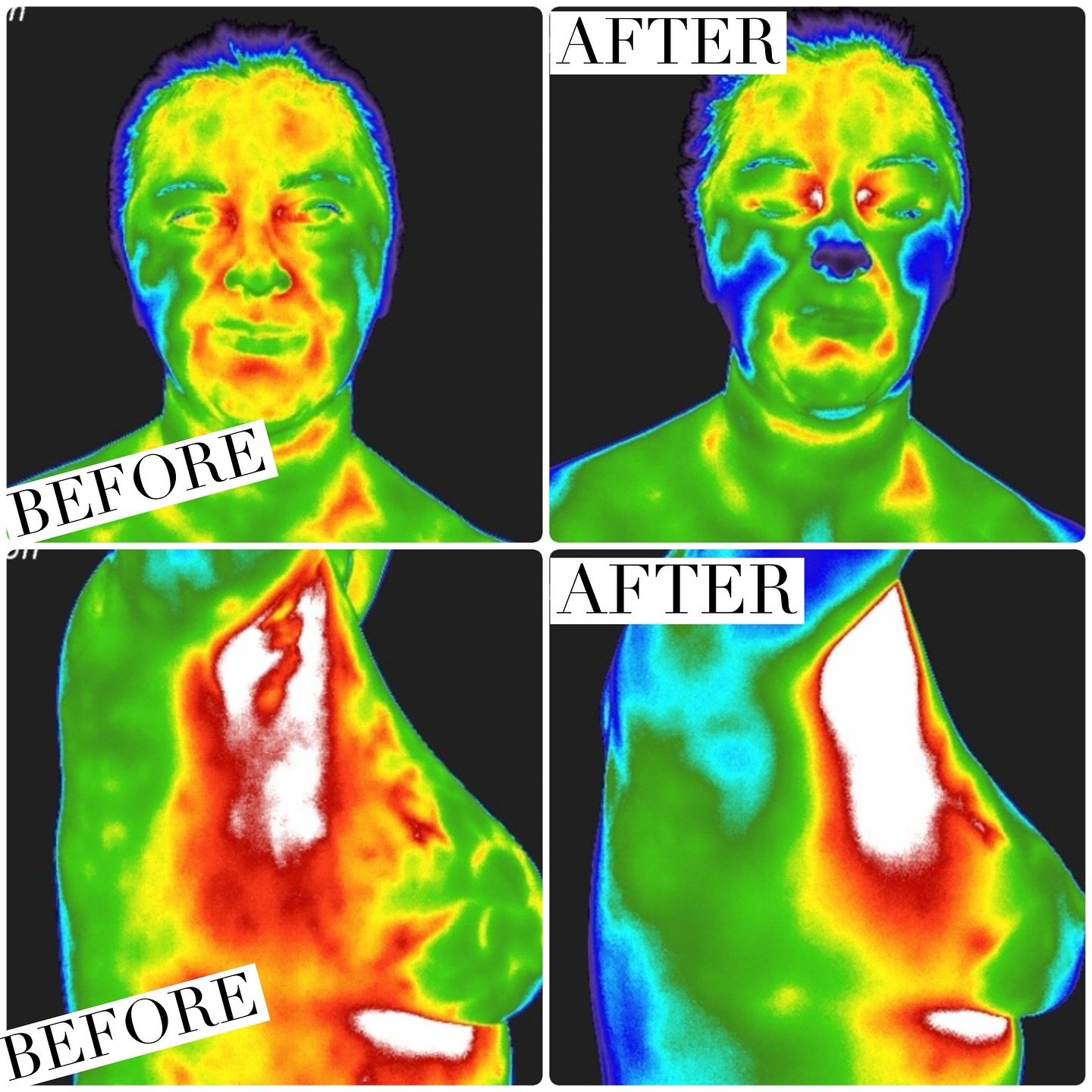 This client came to see me feeling super inflamed and had been eating fairly rich, inflammatory foods. Once we saw her first pictures, she realized we needed to do some adjusting within her lifestyle.
We honestly didn’t do a ton of adjusting,