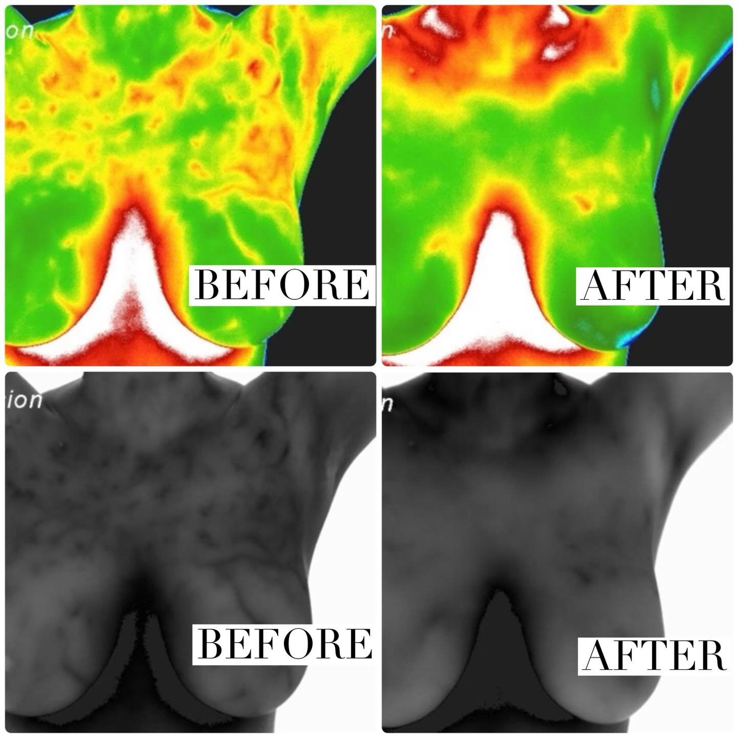 Look at that change!  Over a 3 month period this client added dry brushing daily, 2x a week workouts, frankincense daily on her breast area with avocado oil as the carrier and WOW.  She went from dysregulated to really clear. 

Not only did her pictu