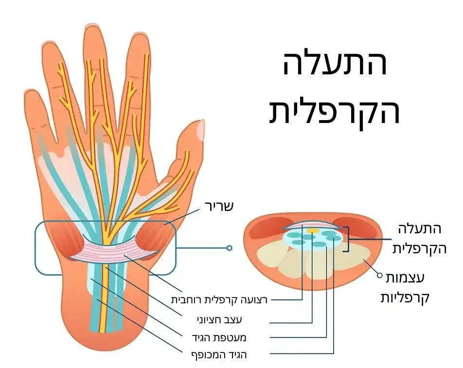 תעלה קרפלית - פתרון ללא ניתוח בעזרת טיפול הידרופרקטיק
