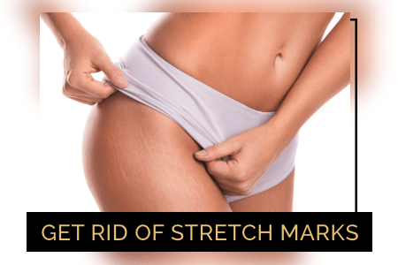 Stretch Marks Removal Before and After Care Tips — You By Sia