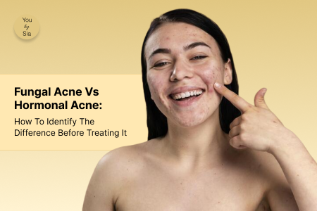 Fungal Acne vs Hormonal Acne: How to Identify the Difference Before Treating It&nbsp;