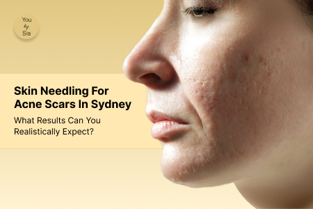 Skin Needling for Acne Scars in Sydney: What Results Can You Realistically Expect?&nbsp;