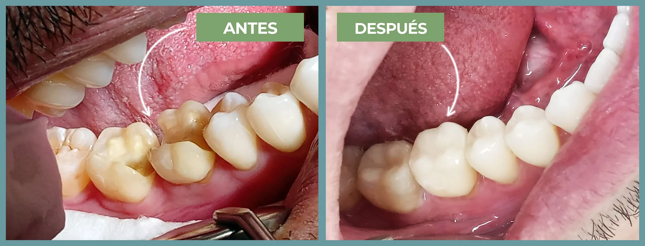 La solución para fracturas dentales: Incrustaciones de Resina — Beyond