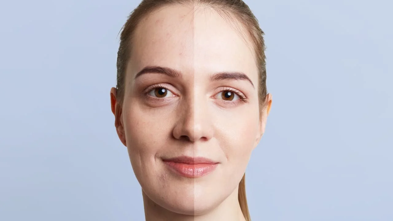 Can Collagen Cause Acne? Uncover the Truth Today