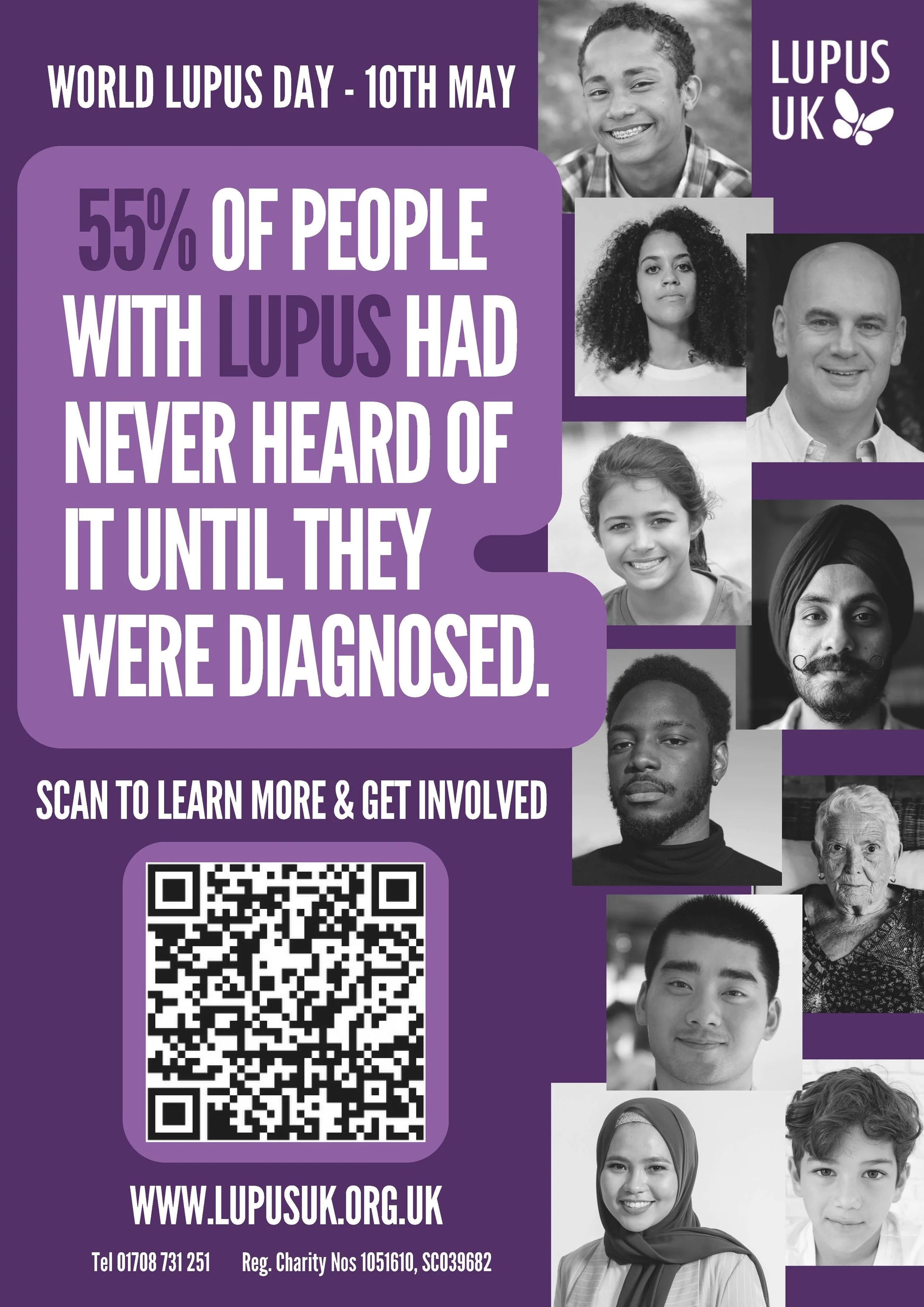 Lupus Unveiled: Understanding the Symptoms, Diagnosis, and Treatment of this Complex Autoimmune Disease