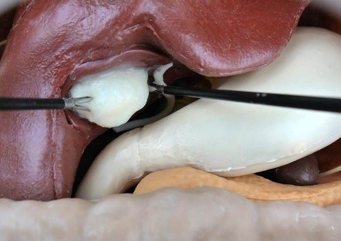 EasySurg_Abdomen_5_962a7f5a-2291-4914-bffd-572687670aec.jpg