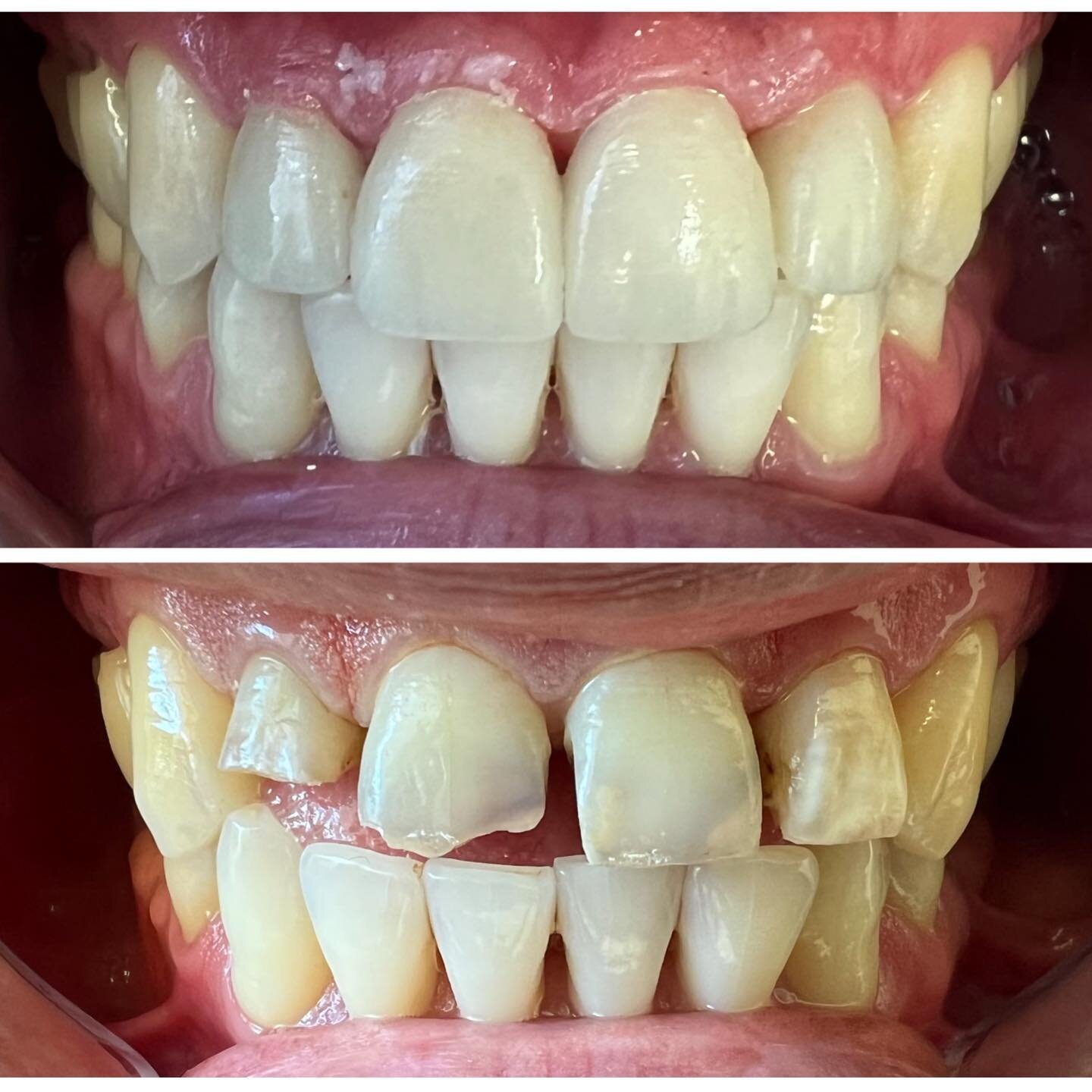 Swipe for the smile. We enjoyed every minute of working on this fantastic patient. Thanks so much for your trust. Here we did a root canal on #7 and core buildups and crowns on #7-10.