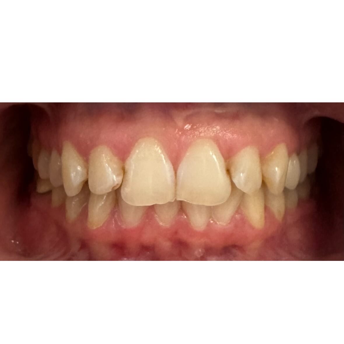 How it started vs how it's going!! Call us to schedule orthodontic treatment. 
#smile #828 #dentalhealth #dental