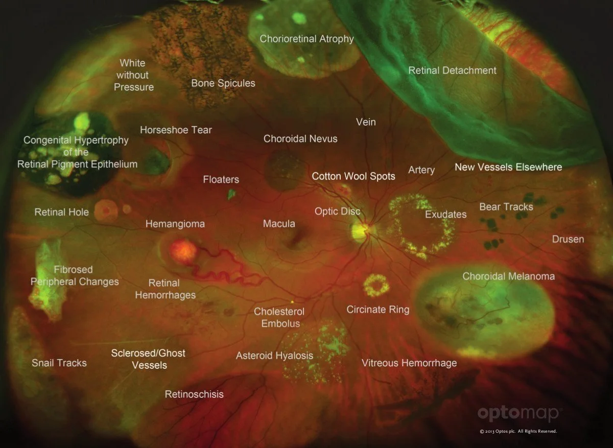 Atrophic Retinal Hole Atrophic Retinal Hole