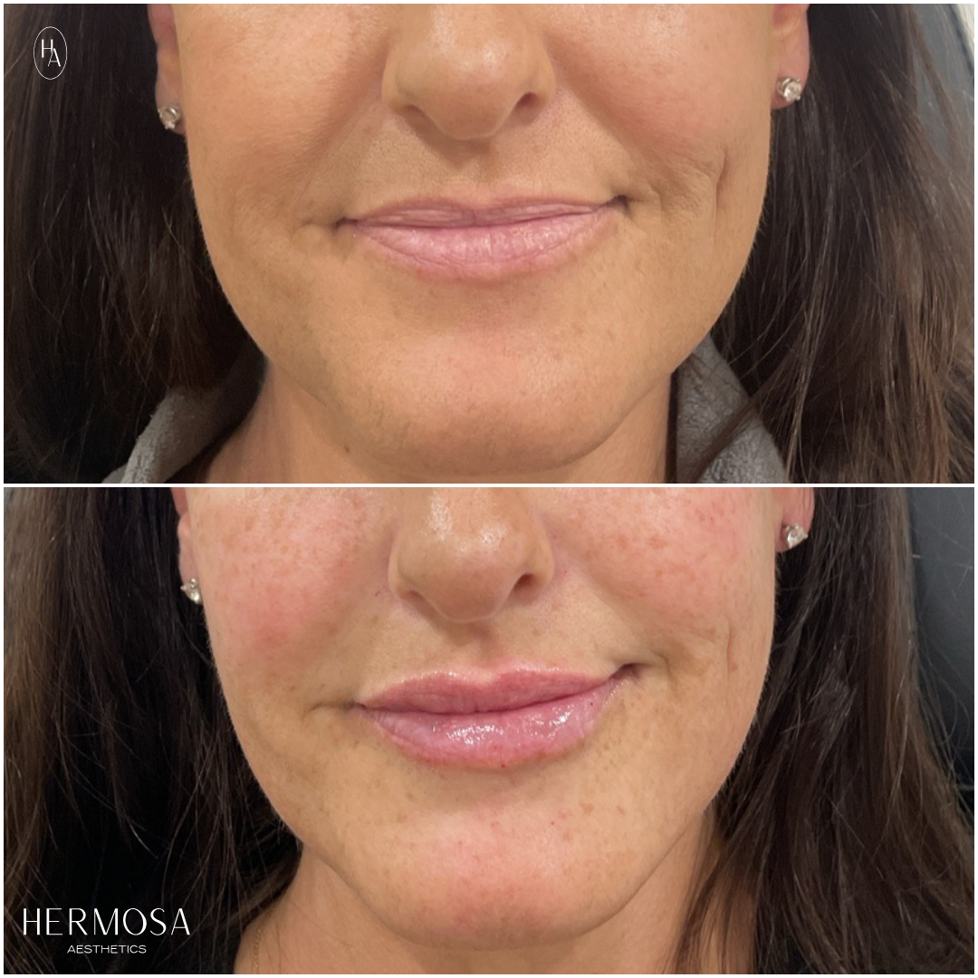 hermosa_lip_filler_2.png