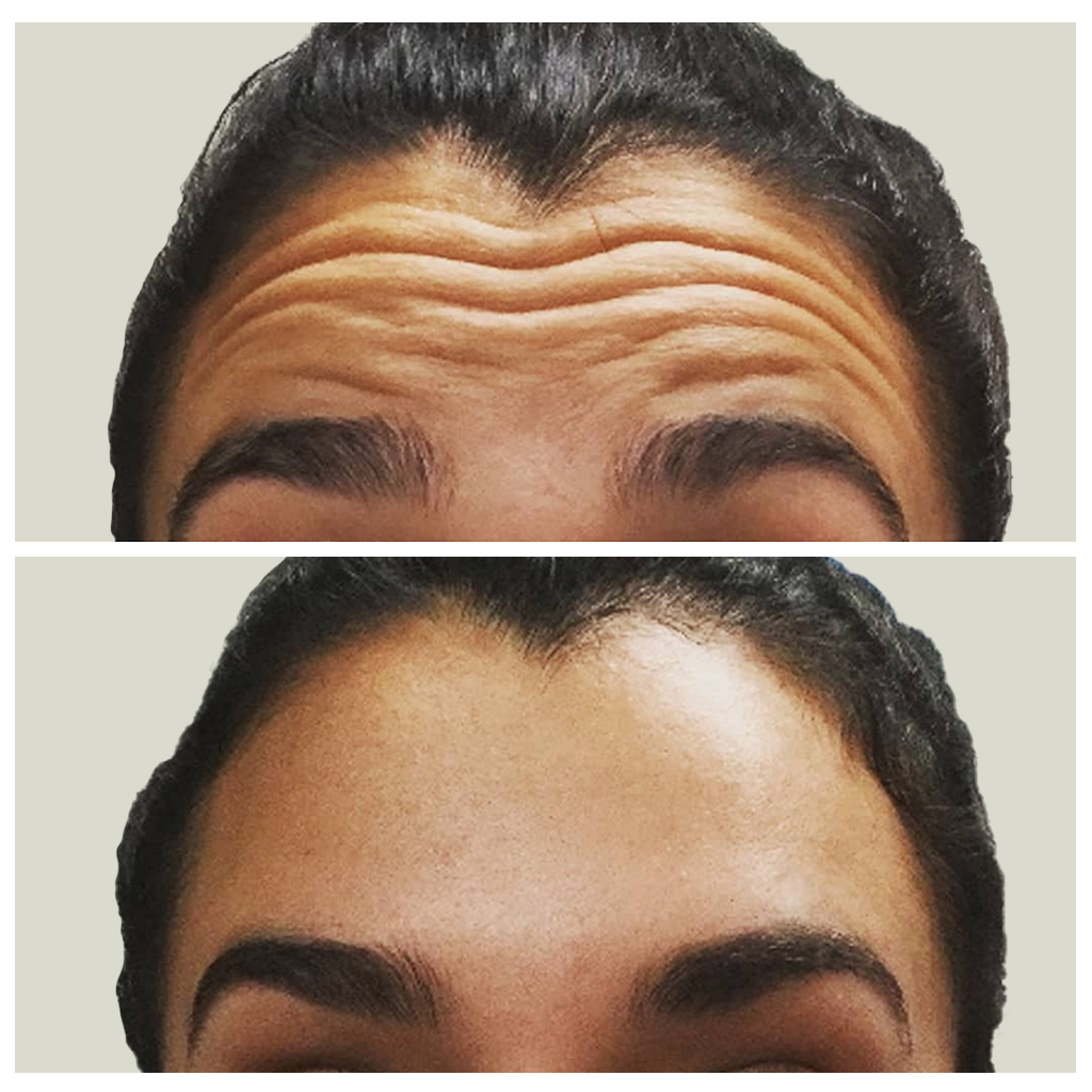 botox.png
