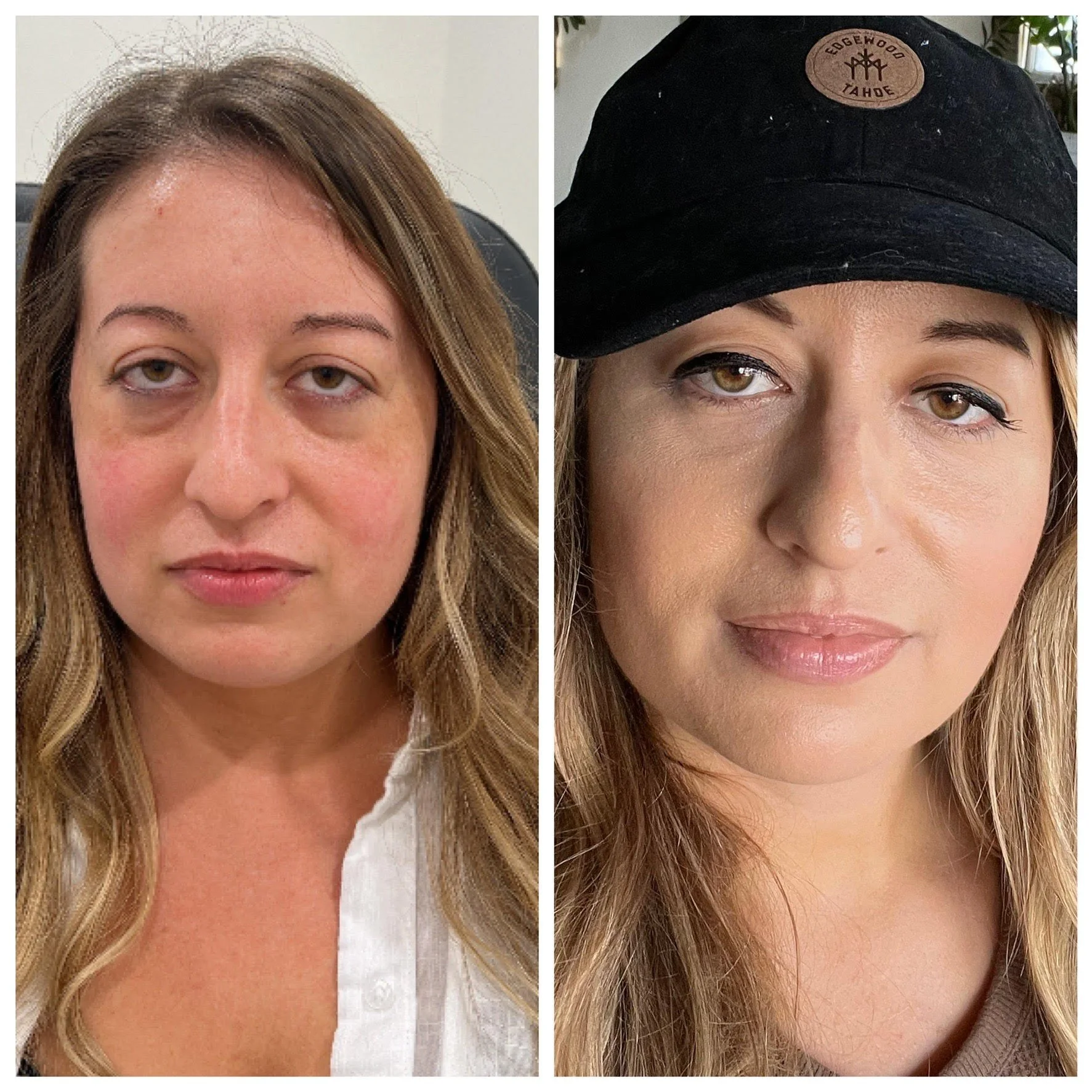 Filler and PRF eyes.jpeg