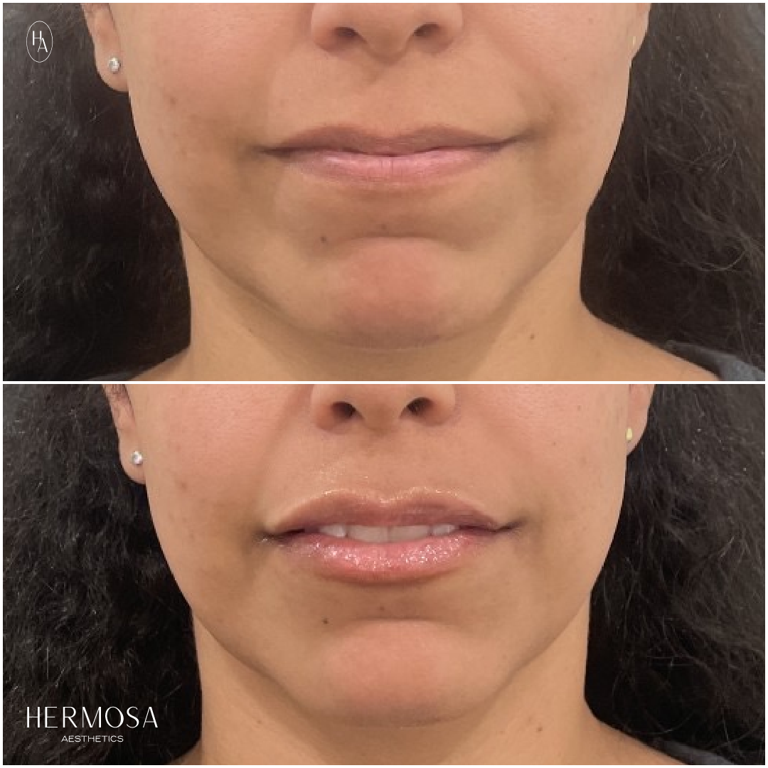 hermosa_lip_filler.png