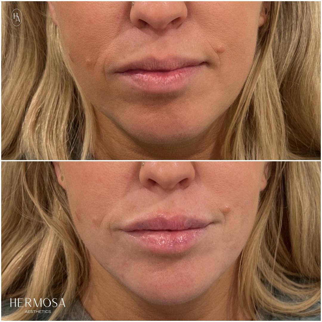 hermosa_lipfiller 3.png
