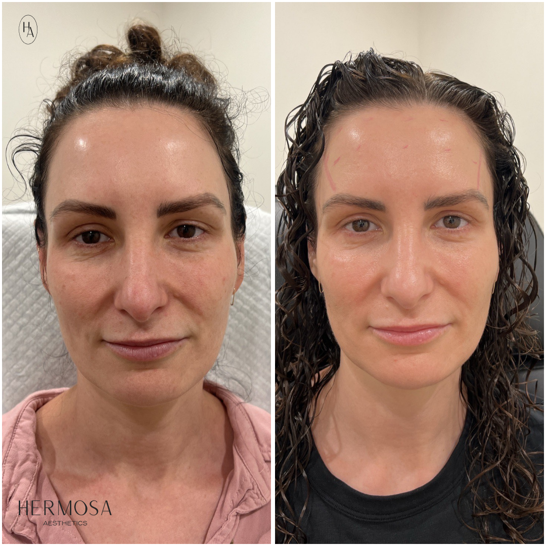 IPL B&A.png