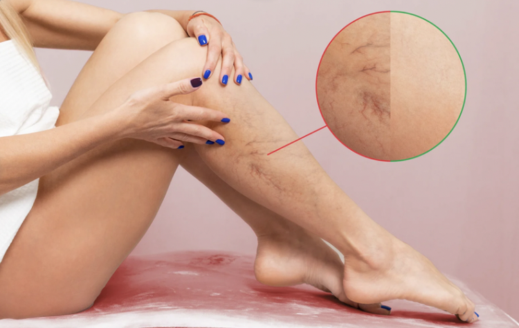 Laser vasculaire et pigmentaire — Centre Laser Villefranche