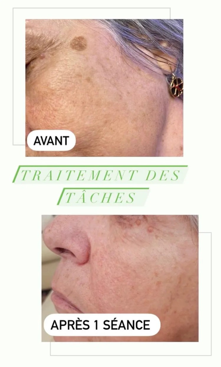 Avant après varicosités laser