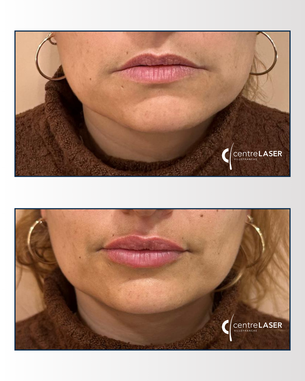 Résultat traitement acide hyaluronique — Centre Laser Villefranche