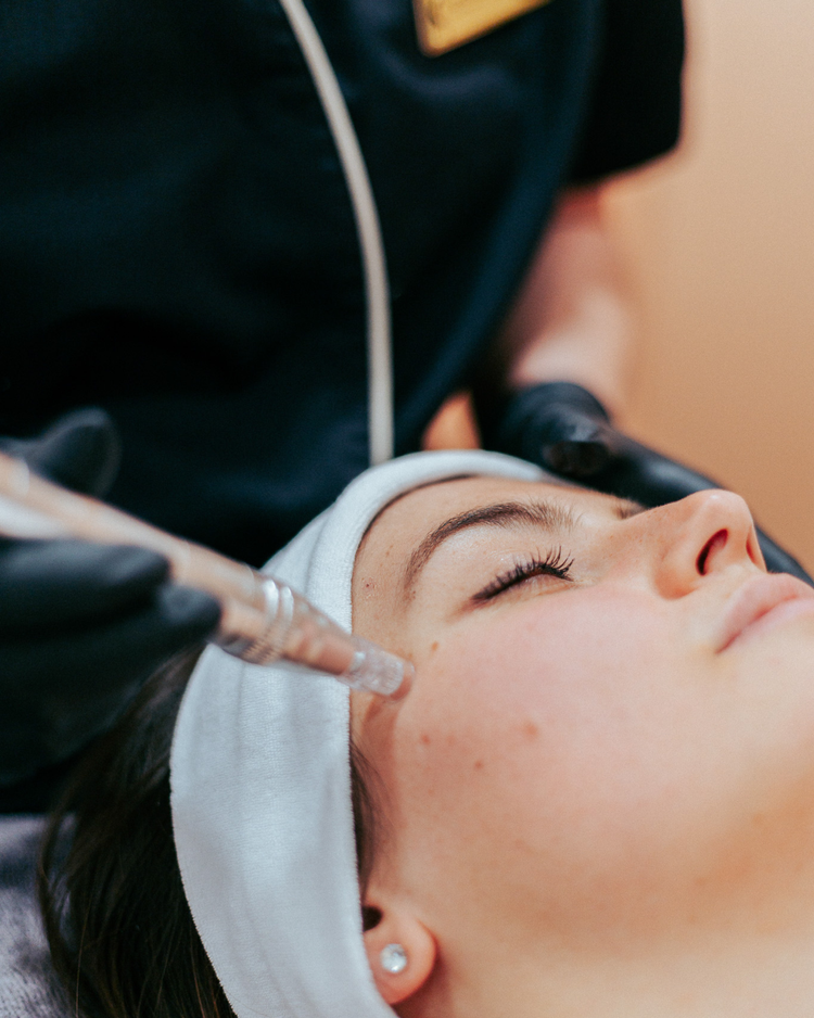 Microneedling — Centre Laser Villefranche