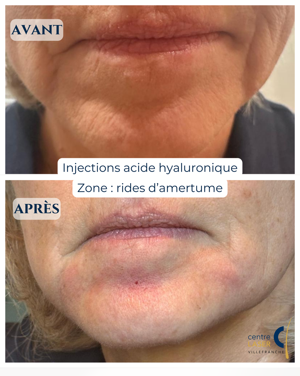 Injections acide hyaluronique — Centre Laser Villefranche