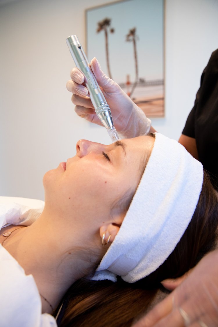 Séance microneedling Centre Laser Villefranche (2)