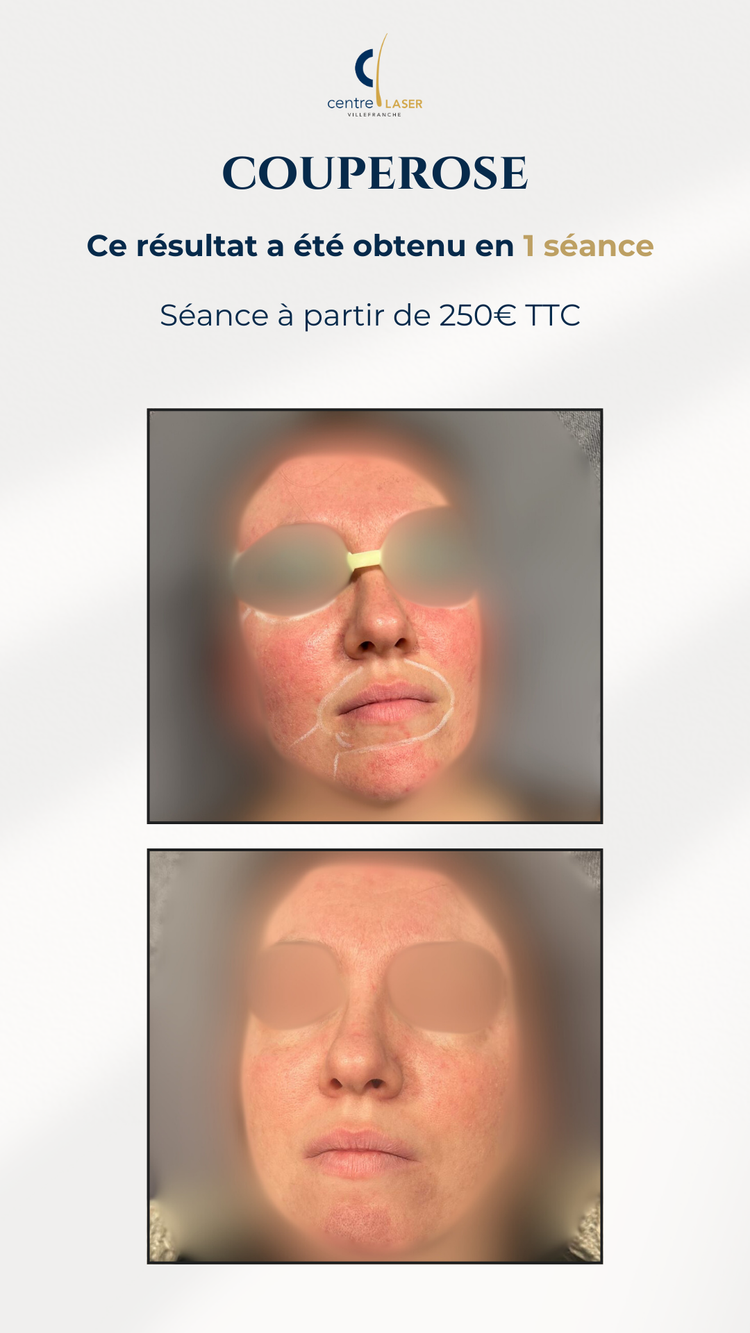 Avant après traitement laser couperose Synchro VasQ — Centre Laser Villefranche