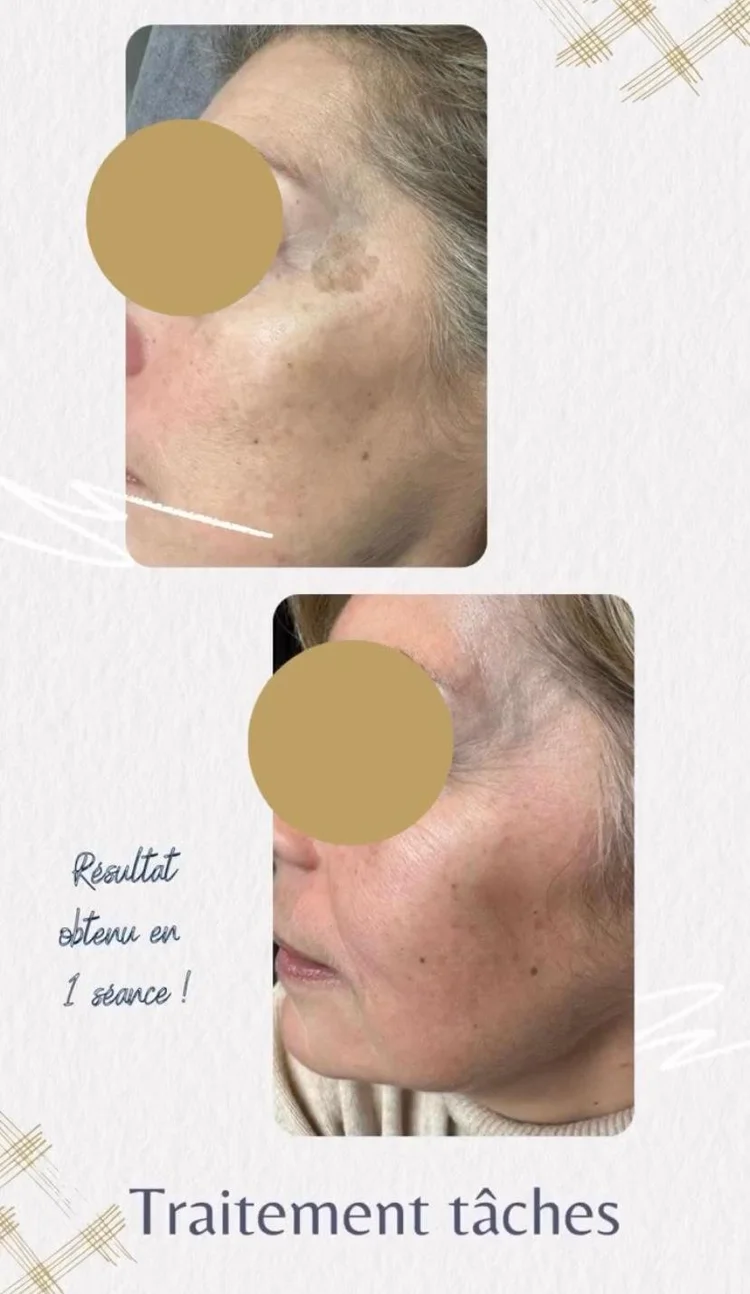 Avant après laser vasculaire varicosités jambes
