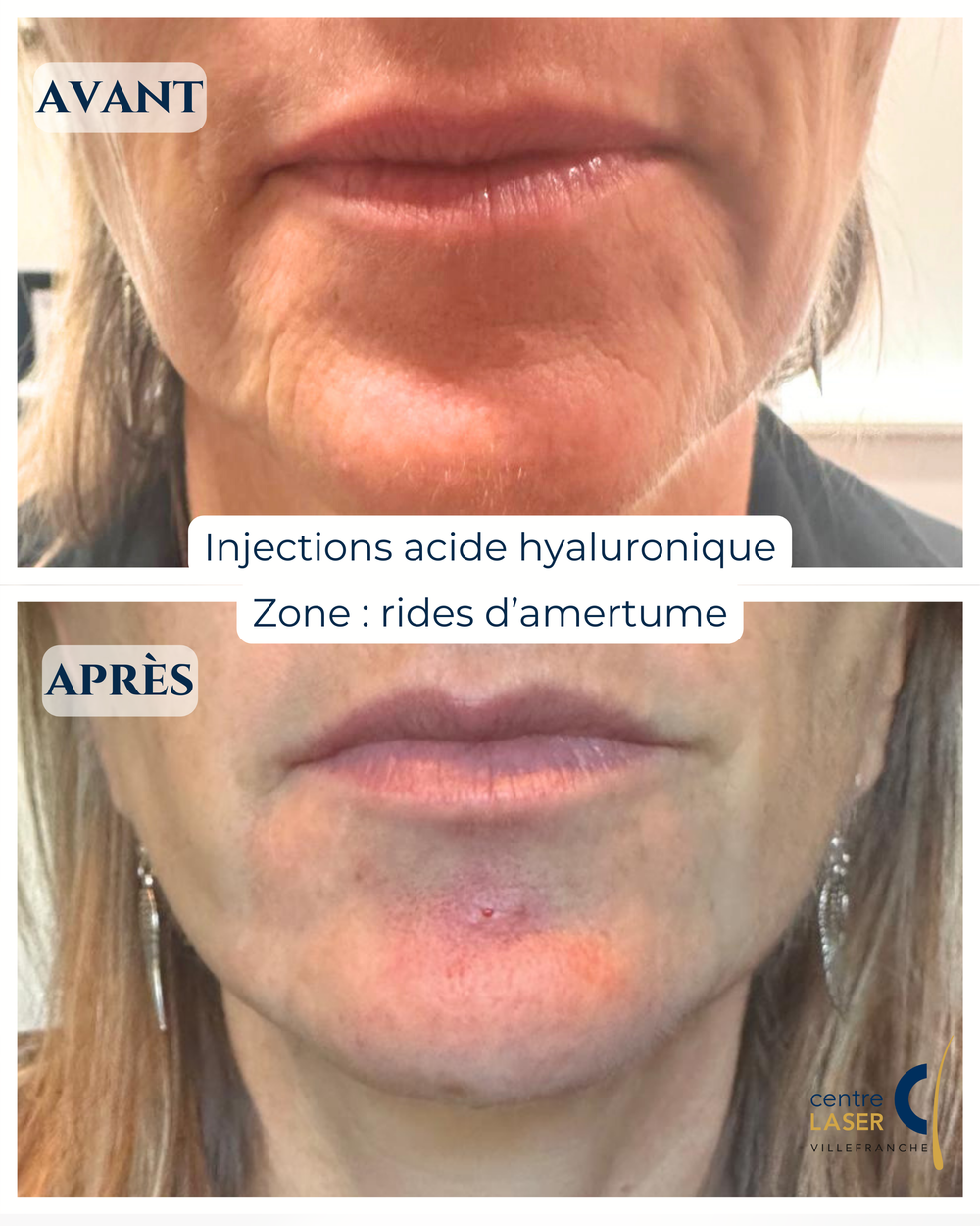 Résultat injection acide hyaluronique lèvres — Centre Laser Villefranche