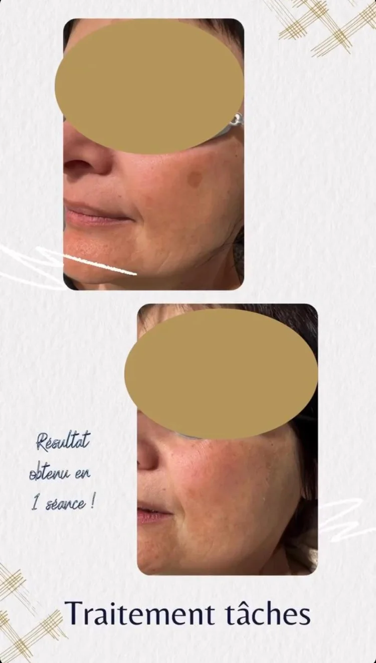 Résultat laser vasculaire jambes