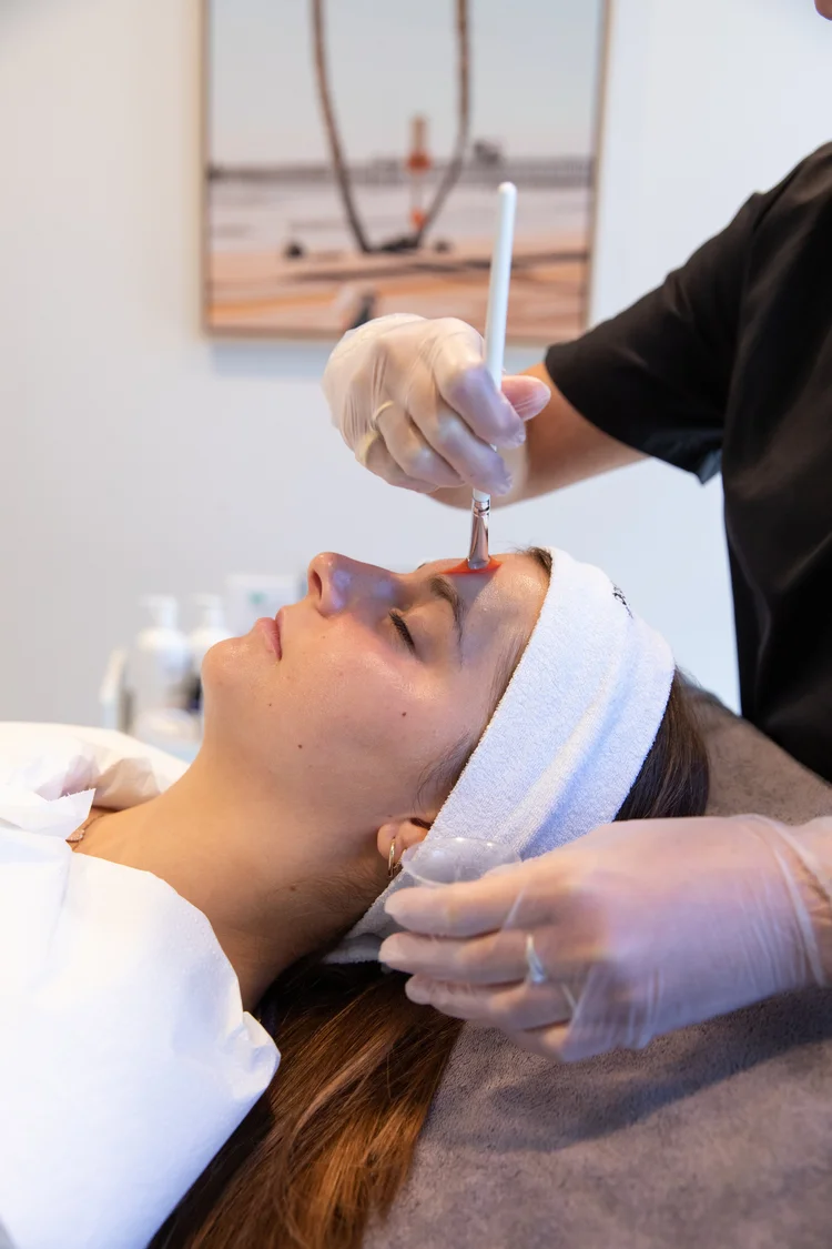 Séance microneedling Centre Laser Villefranche (3)