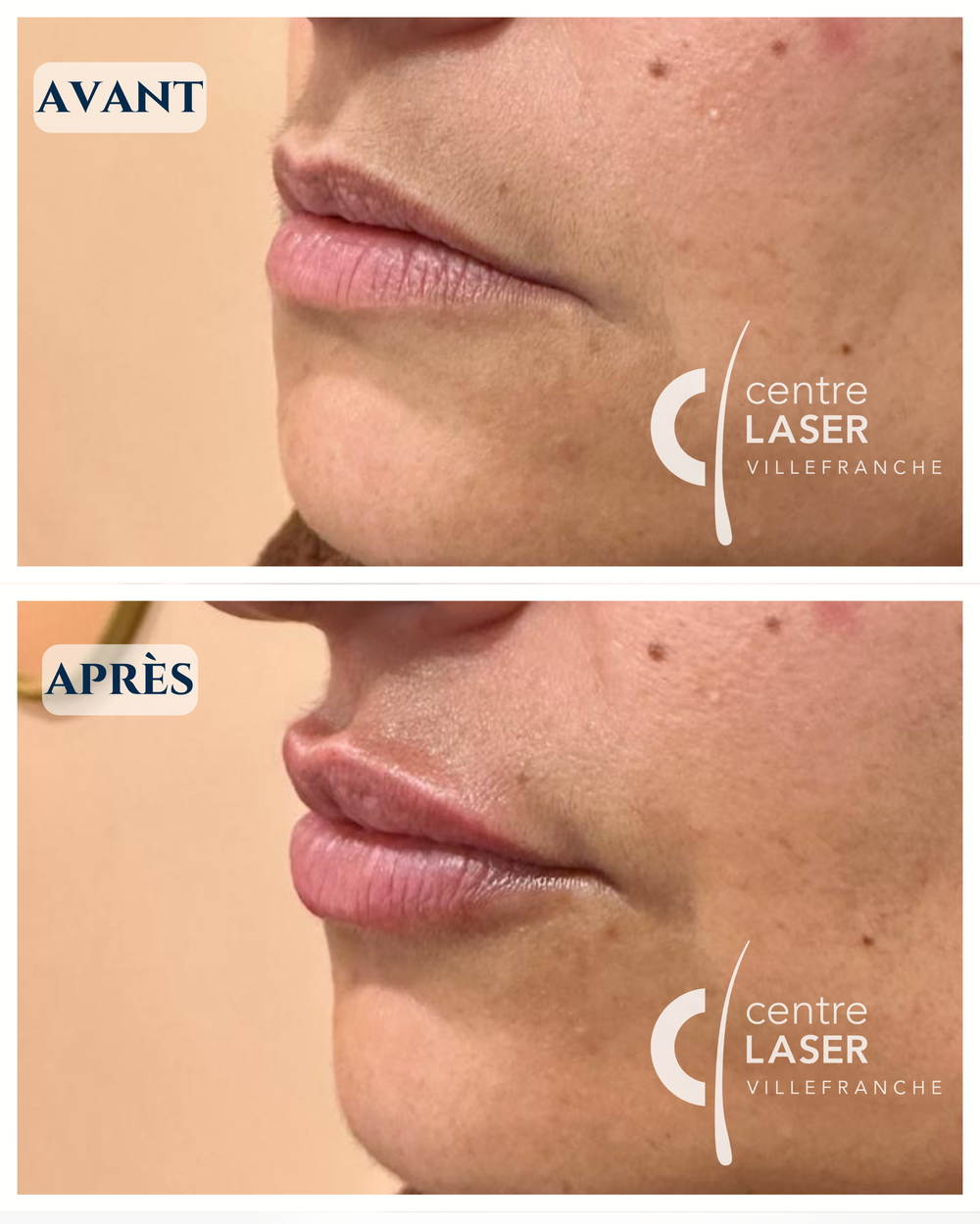 Séance injection acide hyaluronique — Centre Laser Villefranche