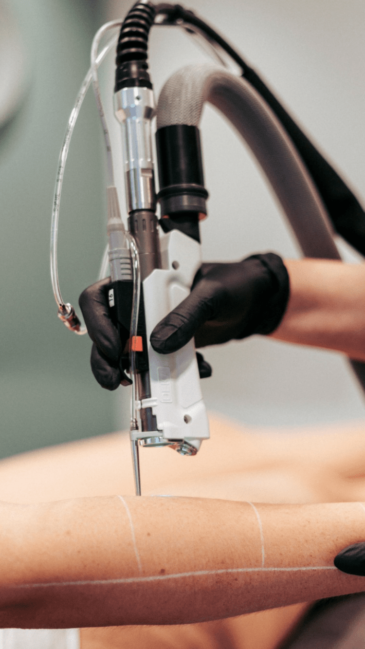 Machine laser Deka — Centre Laser Villefranche