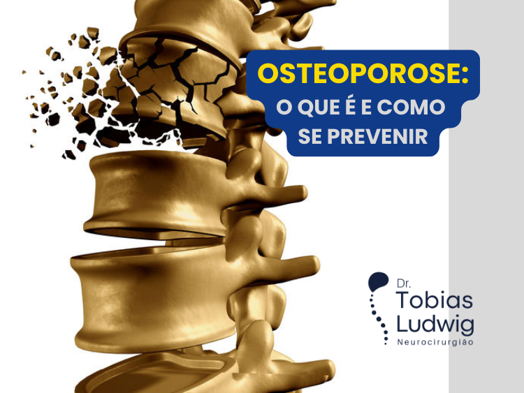 O Que é a Osteoporose e Como se Prevenir