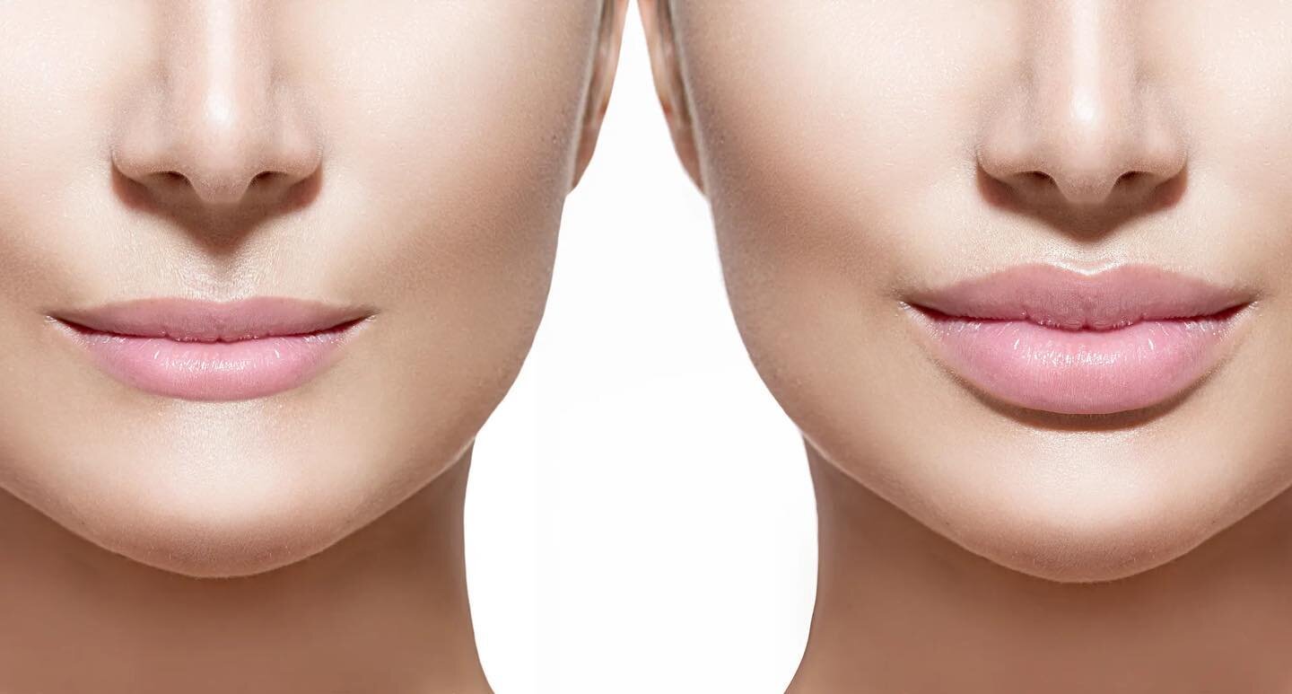 ✨Dreaming of fuller, more-youthful lips? Juvederm can help ✨ Call us for a consultation at 678-282-0051.