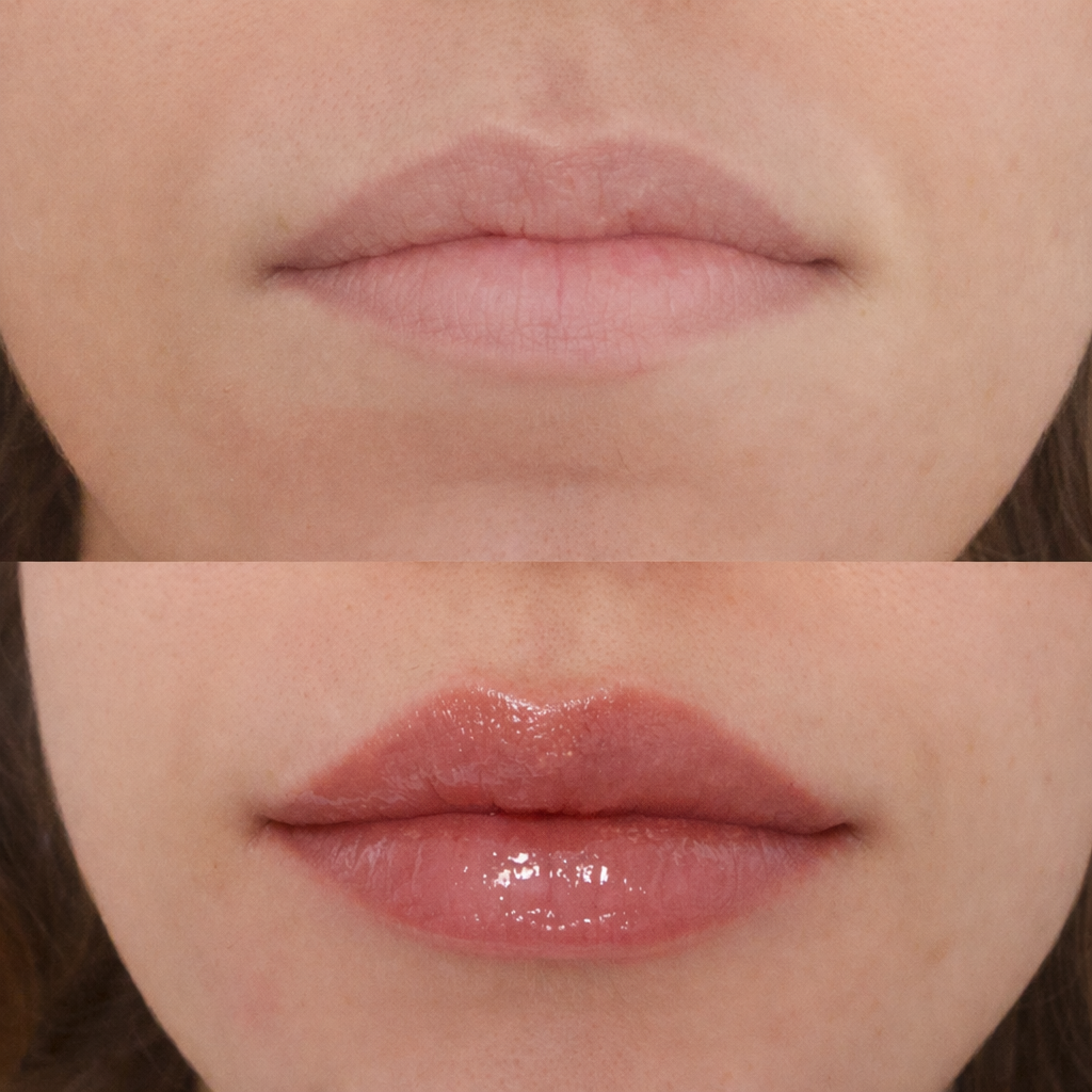 Before and after lip filler treatment improving upper and lower lip balance while maintaining a natural aesthetic.