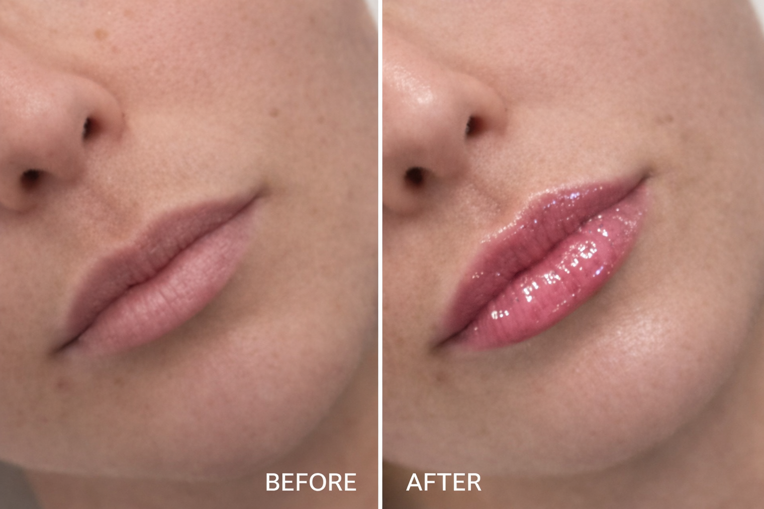 Close-up comparison of lip filler treatment showing soft volume and refined shape for elegant, natural-looking lips.