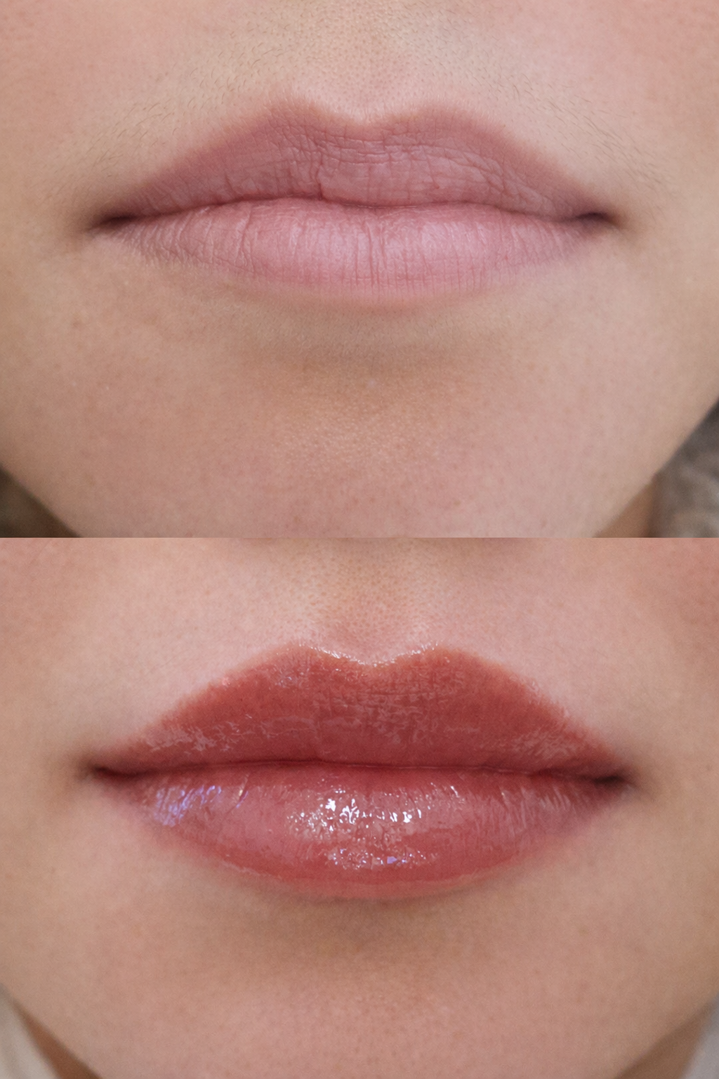 Close-up of a person's lips showing before and after Russian lip filler technique designed to lift the cupid’s bow and create elegant, defined lips without excessive volume.