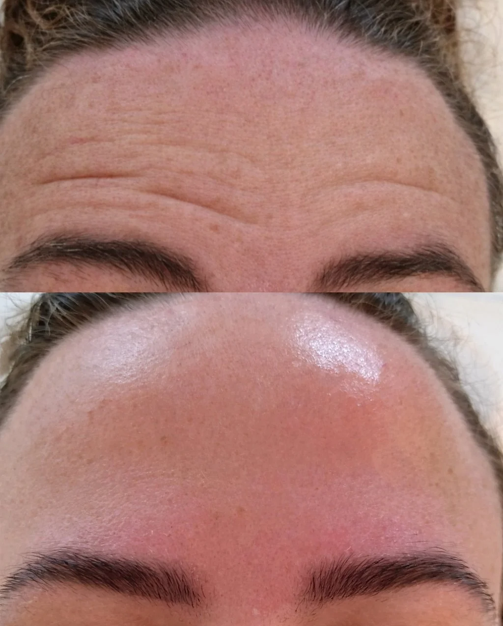 Close-up of a person's forehead showing before and botox anti-wrinkle treatment resulting in softened wrinkles and smoother skin while preserving natural facial expression.