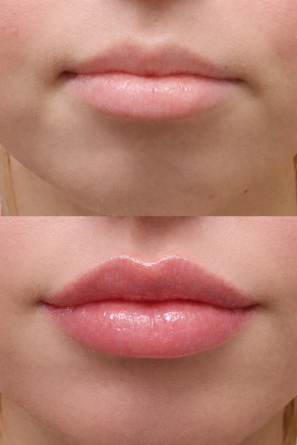 Close-up of a person's lips before and after lip filler injection, showing the lips appear fuller and defined after.