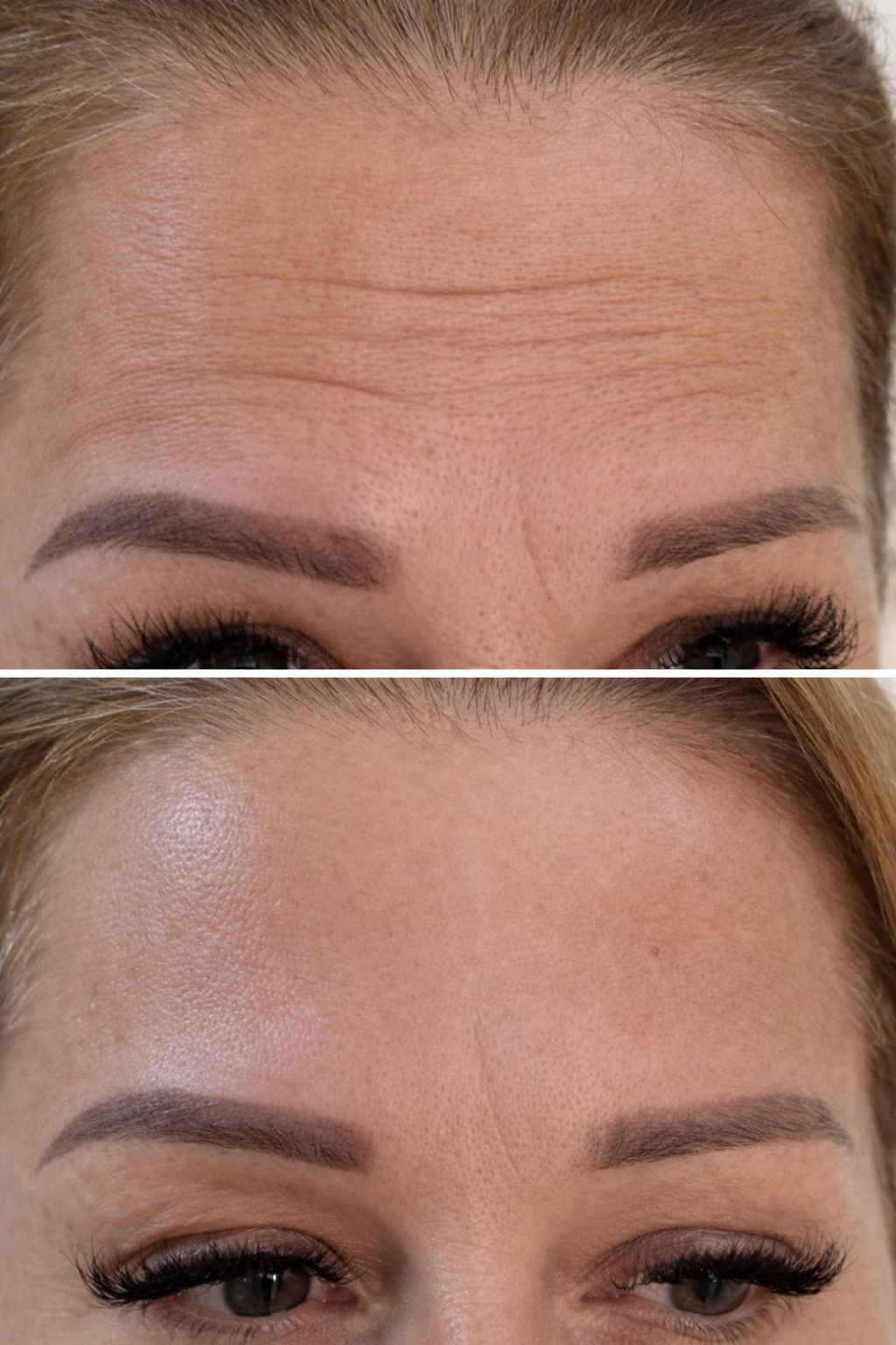 Close-up of a woman's face showing before and after Botox treatment reducing forehead lines while maintaining natural movement and expression.